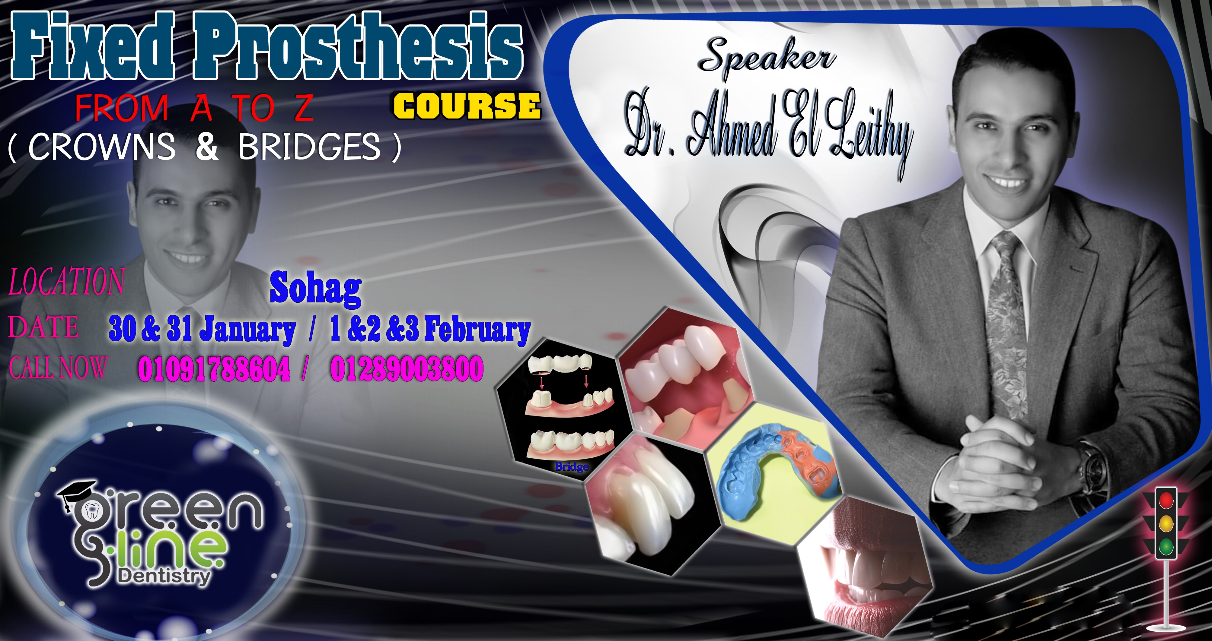 Fixed Prosthesis From A To Z